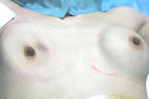 シリコンバッグ抜去