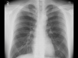 豊胸バッグ抜去